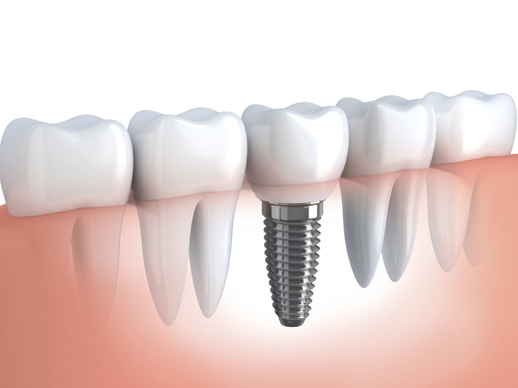 implantes