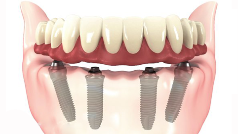 implantes